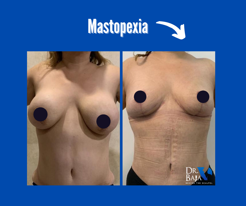 resultado de mastopexia